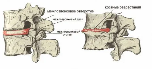 як лікувати спину в бані
