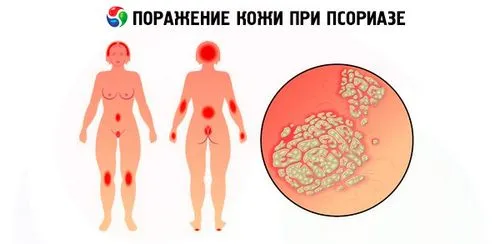 як лікувати псоріаз на ранній стадії