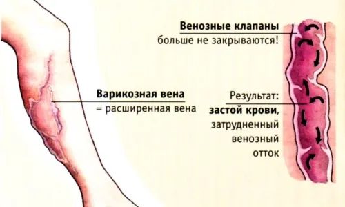 як лікувати судини ніг
