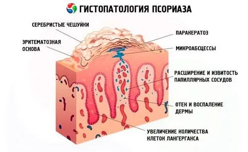початкова стадія псоріазу