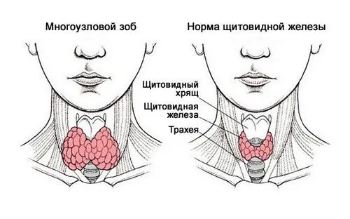 як лікувати багатовузловий зоб