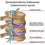 як довго лікувати хондроз шиї