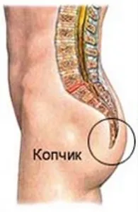 як лікувати хондроз куприка