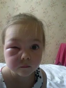 як лікувати лімфовузли на щоці