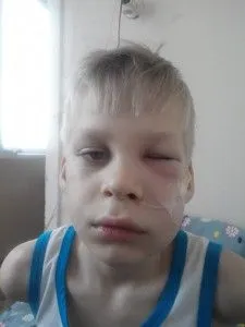 як лікувати лімфовузли на щоці