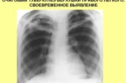 як лікувати вогнищевий туберкульоз