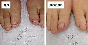 вилікувати грибок нігтів без таблеток
