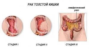 рак кишечника