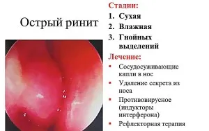 як лікувати гострий риніт