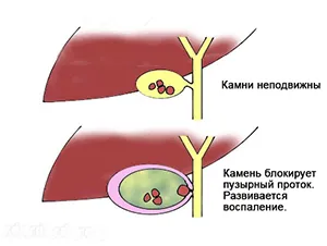 як лікують гострий холецистит