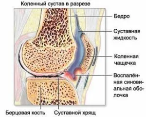 остеопороз колінного суглоба симптоми і лікування