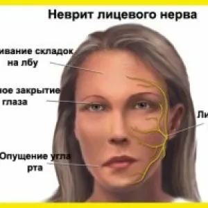 лицьової лікування неврит