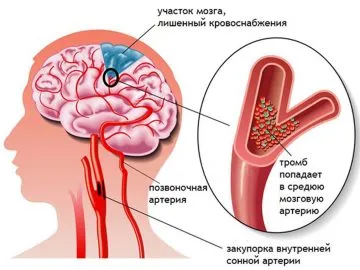 як лікувати судини від холестерину
