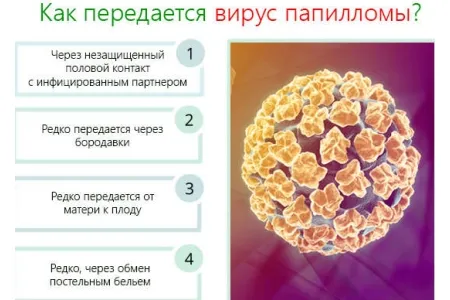 Загострена папілома: види, причини появи, лікування як лікувати гострі папіломи