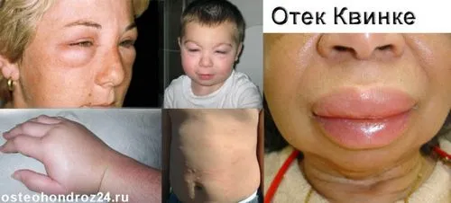 як лікувати алергію набряк Квінке