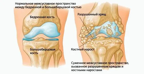 остеохондроз колінного суглоба лікування