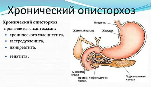 як лікуватися від опісторхозу