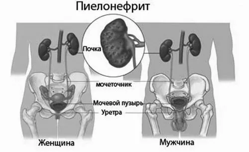 Опущення нирки - симптоми, причини, лікування опущення нирки
