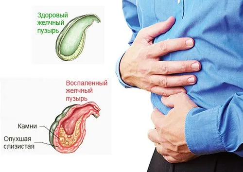 як лікують гострий холецистит