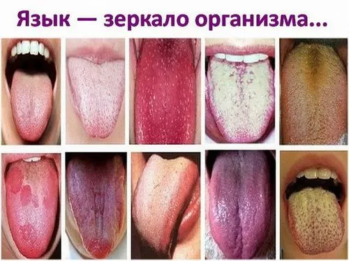 набряк мови причини