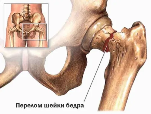 остеопороз симптоми перелом кістки хребці причини лікування