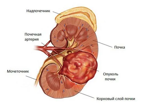 доброякісне нововобразованіе нирок