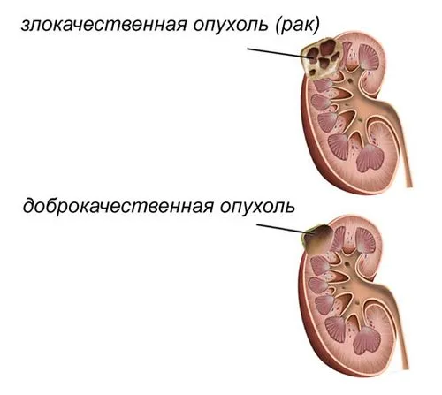 доброякісне нововобразованіе нирок
