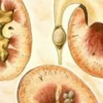 як лікувати нирки при подагрі