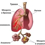 як лікувати дитячу пневмонію