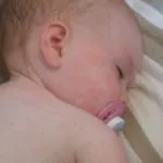 як лікувати висип при вич