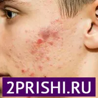 як вилікувати прищі в 15 років