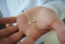 як лікувати нирки якщо в них пісок
