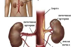 по нирках