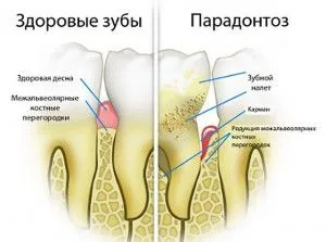 як лікувати ясна народними методами