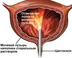 плоскоклітинний рак сечовий міхур папілома діагностика лікування відео стадії фактор ризику