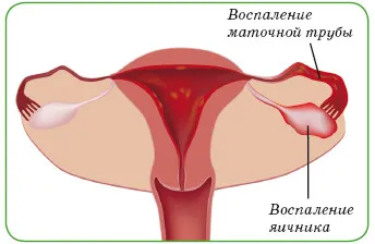 лікування хронічного уреаплазмоза у жінок