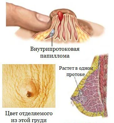 як вивести папіломи під грудьми