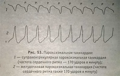 як лікувати пароксизмальну тахікардію