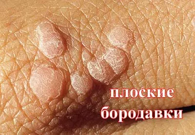 вилікувати плоскі бородавки