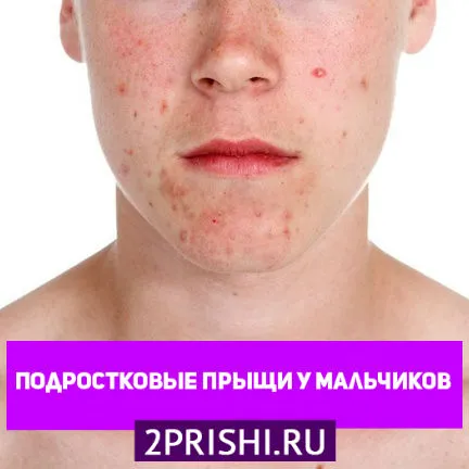 як вилікувати прищі в 15 років