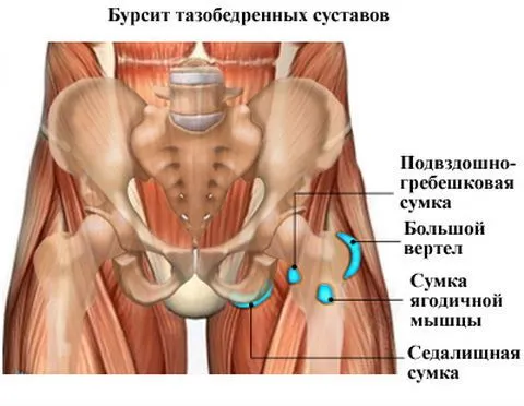 як лікувати суглоби стегна