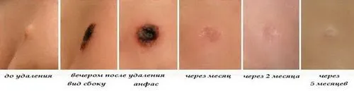 папіломи на шиї причини появи лікування