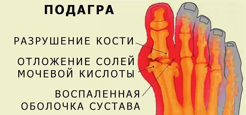 як лікувати подагричний артрит