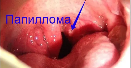 як лікувати папіломи в горлі