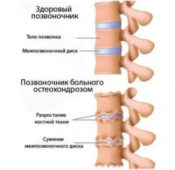як лікувати остеохондроз в попереку
