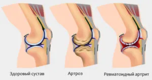 як лікувати артрит артроз