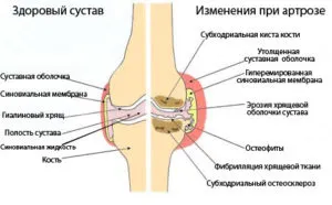 як лікувати артрит артроз
