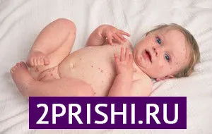 як лікувати прищі на животі