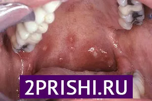 як вилікувати прищі у роті