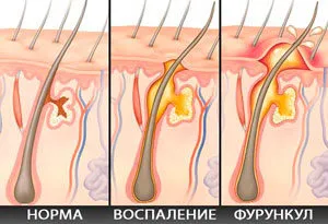 як лікувати фурункул без шраму